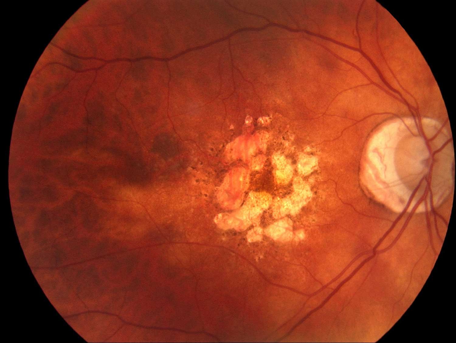 Age-related Macular Degeneration (AMD)